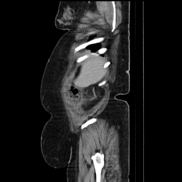 Acute pyelonephritis (Radiopaedia 25657-25837 Sagittal renal parenchymal phase 17).jpg