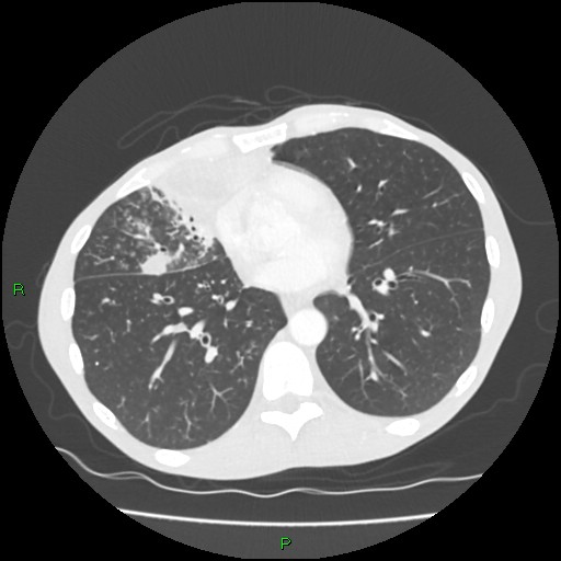 Acute right lung abscess (Radiopaedia 34806-36258 Axial lung window 118).jpg