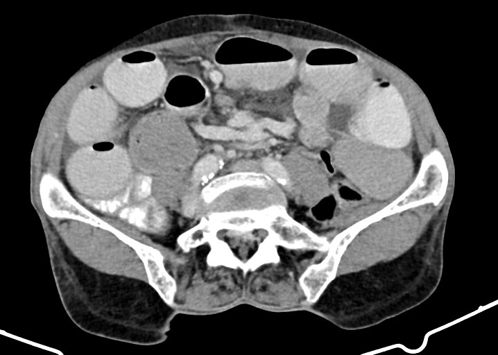 Acute small bowel (ileal) volvulus (Radiopaedia 71740-82139 Axial C+ portal venous phase 136).jpg
