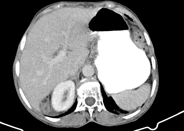 File:Acute small bowel (ileal) volvulus (Radiopaedia 71740-82139 Axial C+ portal venous phase 59).jpg