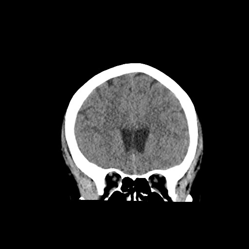 Acute subarachnoid hemorrhage and accessory anterior cerebral artery (Radiopaedia 69231-79008 Coronal non-contrast 25).jpg