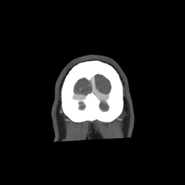 Acute subarachnoid hemorrhage and accessory anterior cerebral artery (Radiopaedia 69231-79009 Coronal C+ arterial phase 79).jpg