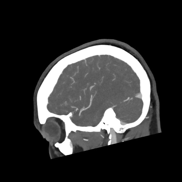 Acute subarachnoid hemorrhage and accessory anterior cerebral artery (Radiopaedia 69231-79009 Sagittal C+ arterial phase 55).jpg