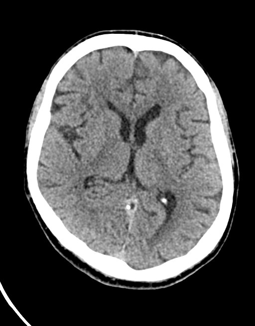 Acute superior cerebellar artery territory infarct (Radiopaedia 84104-99359 Axial non-contrast 35).jpg