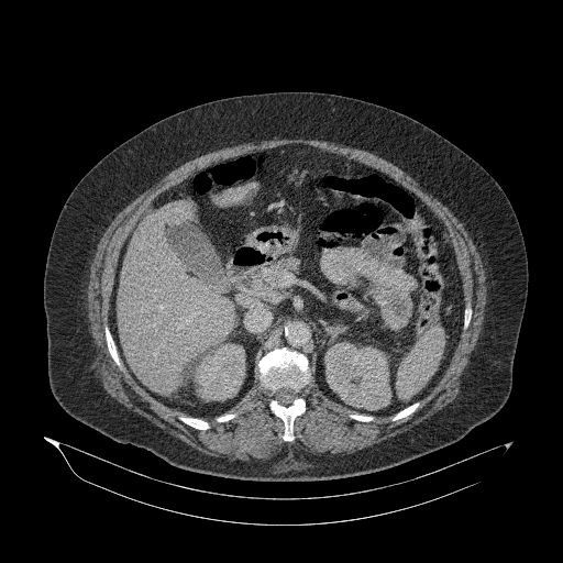 Acute superior mesenteric artery occlusion (Radiopaedia 51288-56960 Axial C+ portal venous phase 34).jpg