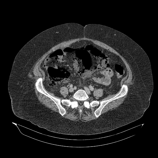 Acute superior mesenteric artery occlusion (Radiopaedia 51288-56960 Axial C+ portal venous phase 71).jpg