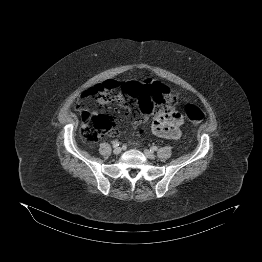 Acute superior mesenteric artery occlusion (Radiopaedia 51288-56960 Axial C+ portal venous phase 73).jpg