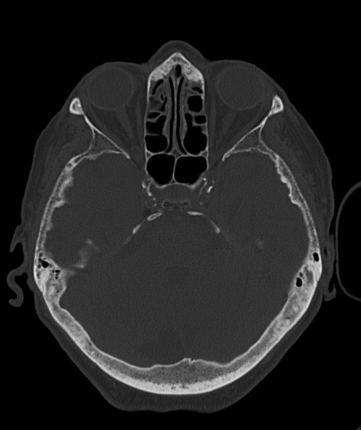 Acute traumatic subdural hematoma (Radiopaedia 82921-97257 Axial bone window 74).jpg