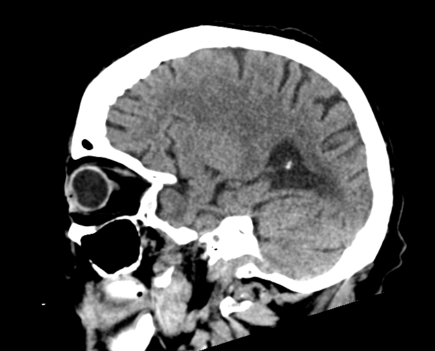 Acute traumatic subdural hematoma (Radiopaedia 82921-97257 Sagittal non-contrast 50).jpg