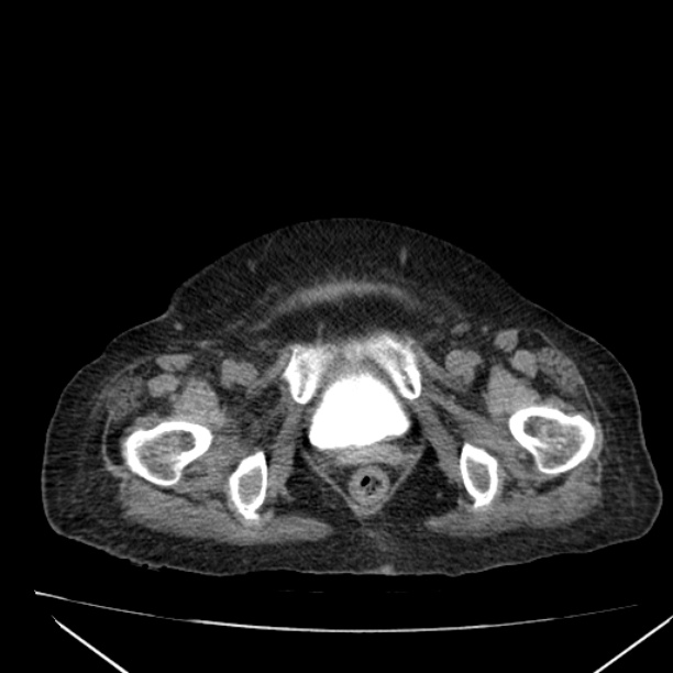 Acute tubular necrosis (Radiopaedia 28077-28334 Axial non-contrast 68).jpg
