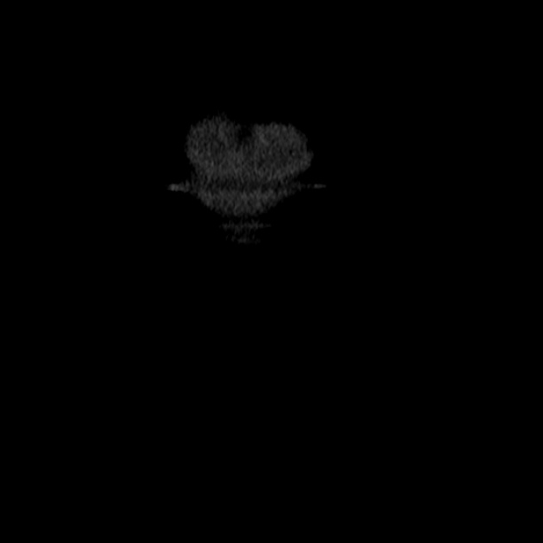 Acute tubular necrosis (Radiopaedia 28077-28334 D 2).jpg