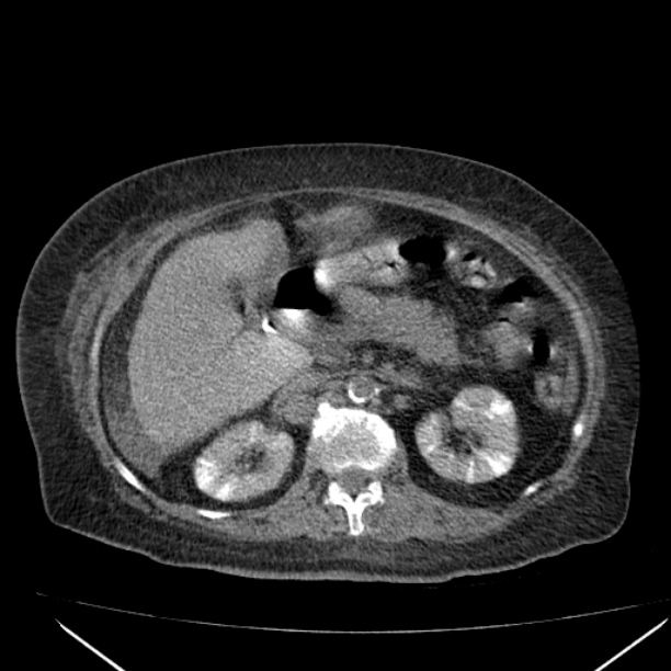 Acute tubular necrosis (Radiopaedia 28077-28334 F 27).jpg