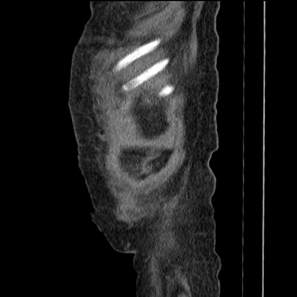 Acute tubular necrosis (Radiopaedia 28077-28334 Sagittal non-contrast 9).jpg