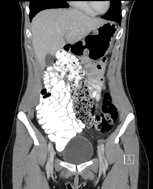 Acute uncomplicated appendicitis (Radiopaedia 61374-69304 Coronal C+ portal venous phase 28).jpg