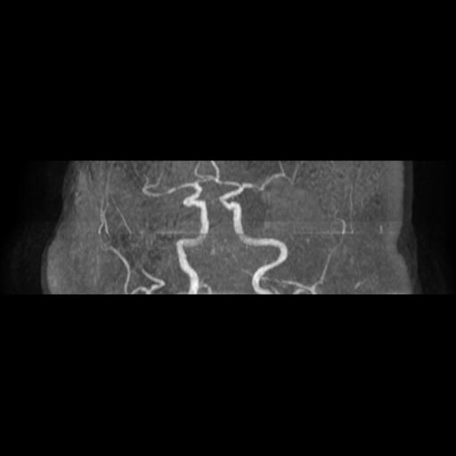 File:Acute vertebrobasilar ischemic infarction (Radiopaedia 25220-25474 Axial MRA 8).jpg
