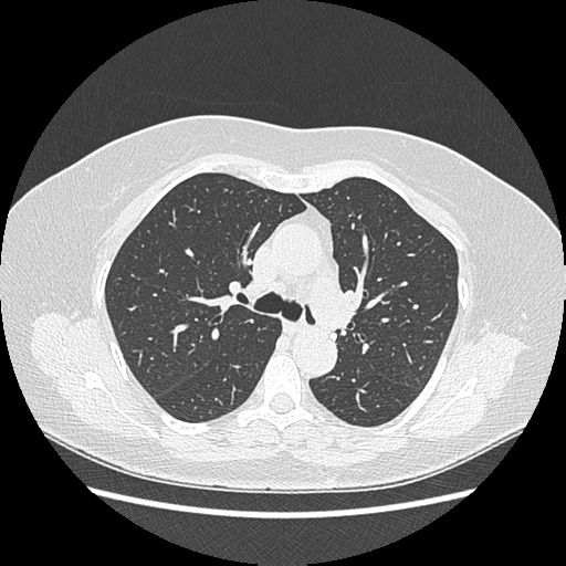 Adenocarcinoma in situ of lung (Radiopaedia 38685-40829 B 86).png