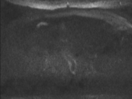 Adenocarcioma of rectum- T1 lesion (Radiopaedia 36921-38546 Axial DWI 79).png
