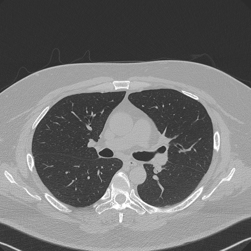 Adenoid cystic carcinoma of the trachea (Radiopaedia 49042-54137 Axial lung window 149).jpg