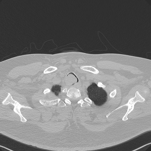 Adenoid cystic carcinoma of the trachea (Radiopaedia 49042-54137 Axial lung window 26).jpg