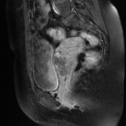 File:Adenoma malignum of cervix (Radiopaedia 66441-75705 Sagittal T1 C+ fat sat 13).jpg