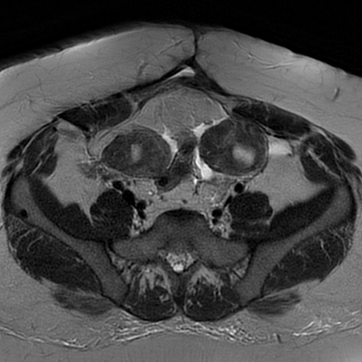 File:Adenomyosis within a didelphys uterus (Radiopaedia 70175-80215 Axial T2 9).jpg