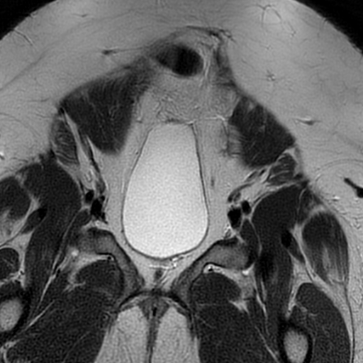 File:Adenomyosis within a didelphys uterus (Radiopaedia 70175-80215 Coronal T2 7).jpg