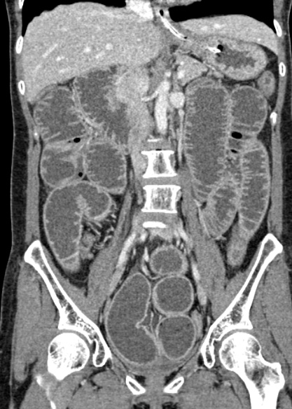 Adhesional small bowel obstruction (Radiopaedia 48397-53305 Coronal C+ portal venous phase 178).jpg