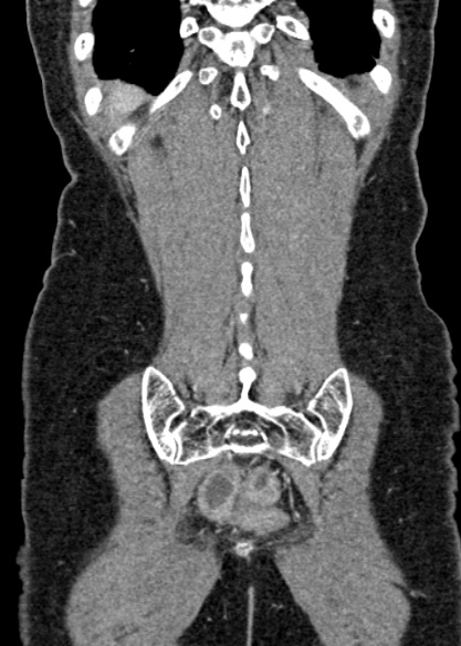Adhesional small bowel obstruction (Radiopaedia 48397-53305 Coronal C+ portal venous phase 304).jpg
