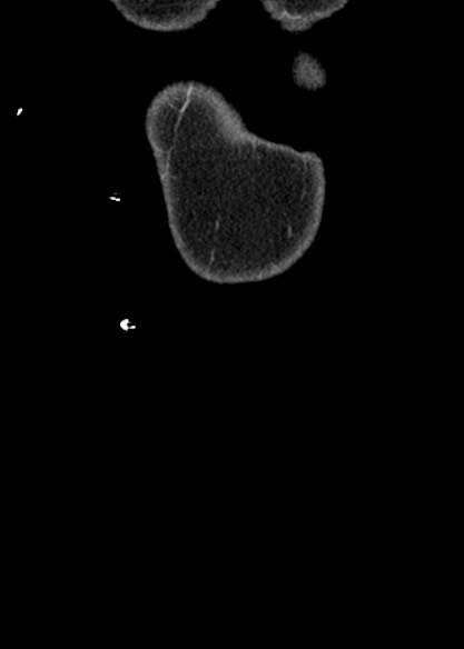 Adhesional small bowel obstruction (Radiopaedia 48397-53305 Coronal C+ portal venous phase 7).jpg