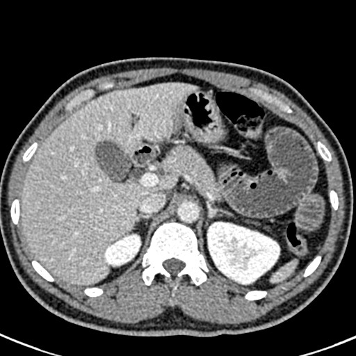 Adhesional small bowel obstruction (Radiopaedia 58900-66131 Axial C+ portal venous phase 14).jpg
