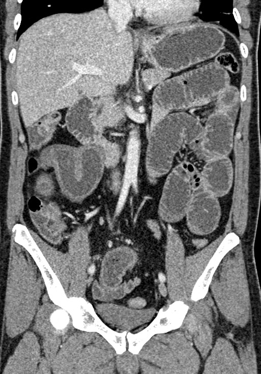 Adhesional small bowel obstruction (Radiopaedia 58900-66131 Coronal C+ portal venous phase 136).jpg