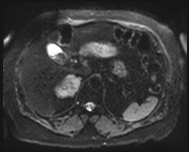Adrenal cortical carcinoma (Radiopaedia 64017-72770 Axial DWI 12).jpg