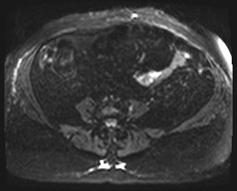 Adrenal cortical carcinoma (Radiopaedia 64017-72770 Axial DWI 43).jpg
