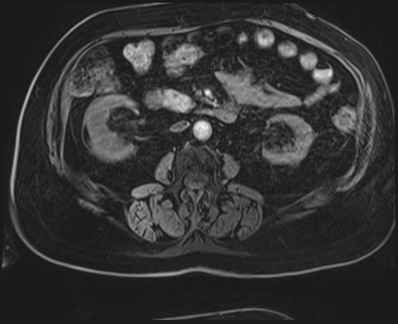 Adrenal cortical carcinoma (Radiopaedia 64017-72770 H 30).jpg