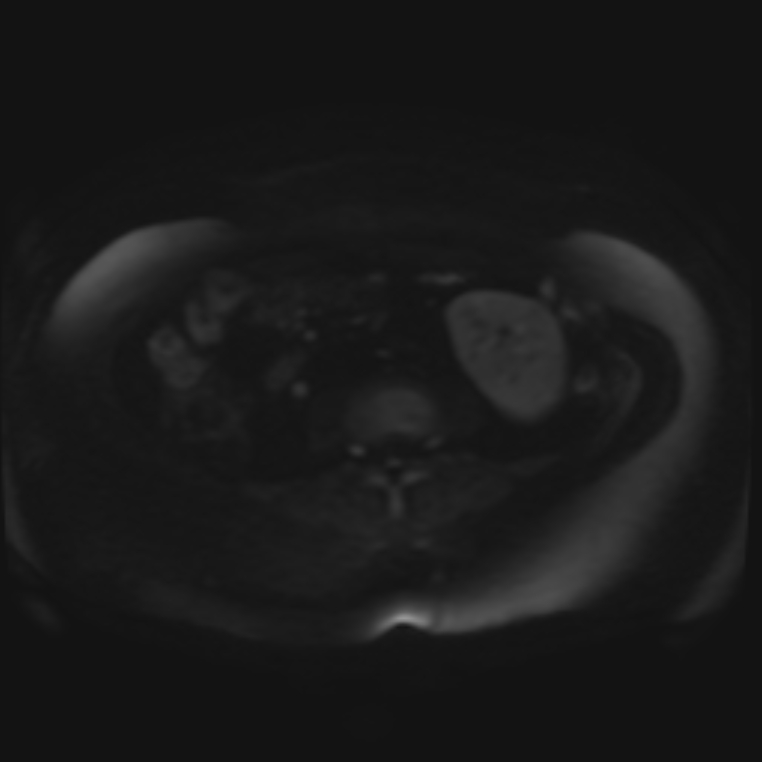 Adrenal cortical carcinoma (Radiopaedia 70906-81116 Axial DWI 53).jpg