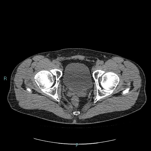 Adrenal cystic lymphangioma (Radiopaedia 83161-97534 Axial non-contrast 94).jpg