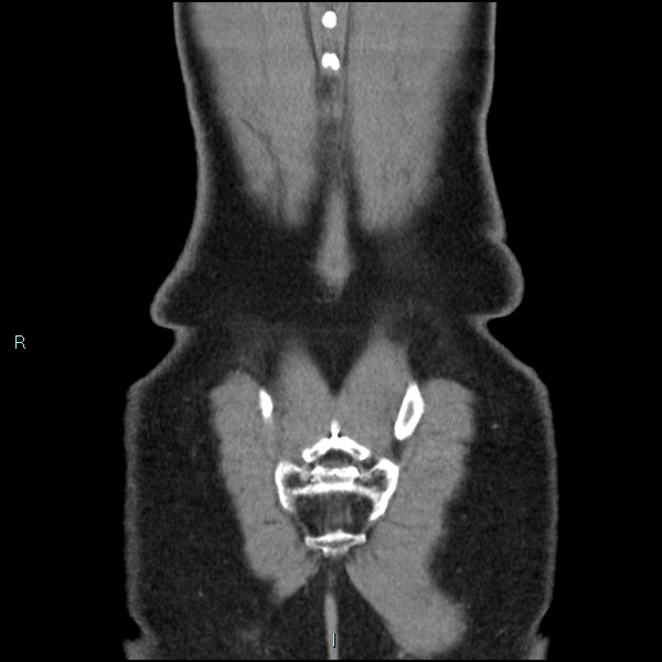 File:Adrenal cystic lymphangioma (Radiopaedia 83161-97534 Coronal C+ portal venous phase 74).jpg