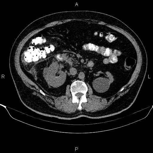 Adrenal hemorrhage (Radiopaedia 62622-70916 Axial non-contrast 81).jpg