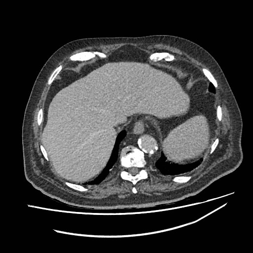 Adrenal lymphoma (Radiopaedia 84145-99415 Axial C+ portal venous phase 5).jpg