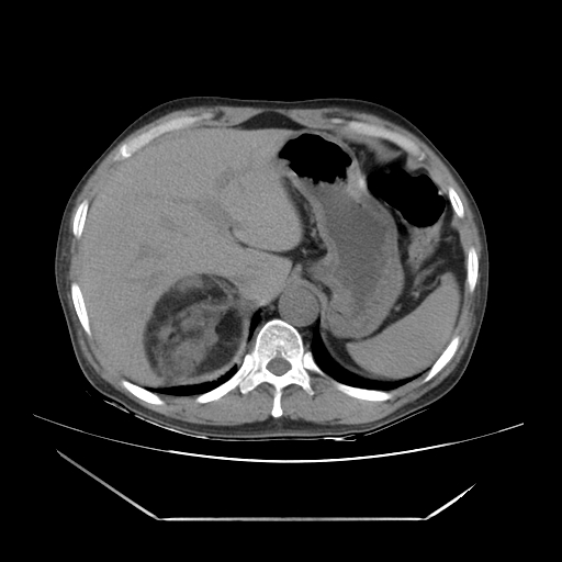 File:Adrenal myelolipoma (Radiopaedia 41843-44834 Axial non-contrast 11).jpg