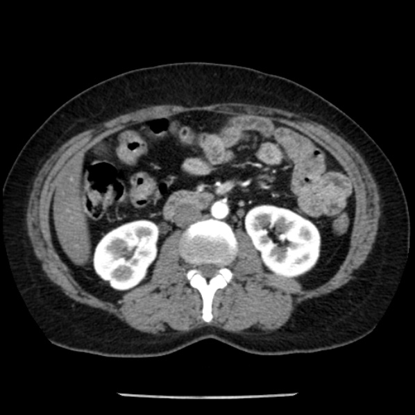 Adrenal myelolipoma (Radiopaedia 43401-46759 Axial C+ arterial phase 49).jpg