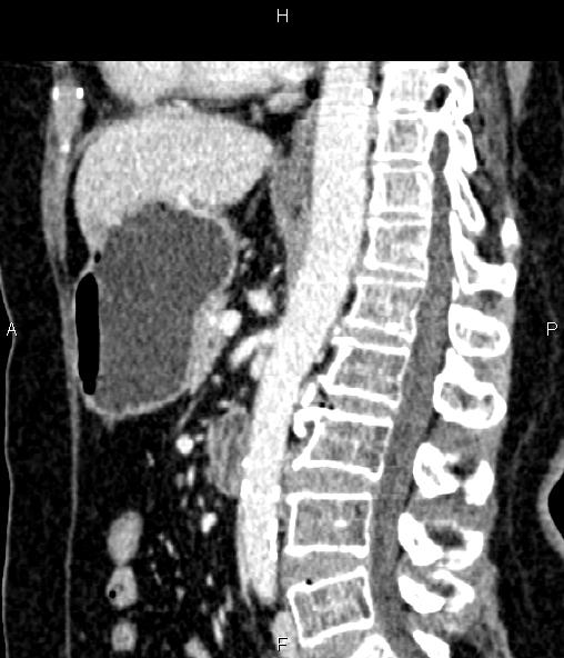 Adrenal myelolipoma (Radiopaedia 82742-96986 Sagittal renal cortical phase 59).jpg