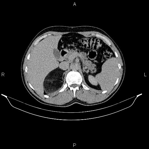 Adrenal myelolipoma (Radiopaedia 87794-104246 Axial renal excretory phase 29).jpg