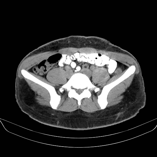 Adrenal myelolipoma - bilateral (Radiopaedia 74805-85810 Axial non-contrast 55).jpg