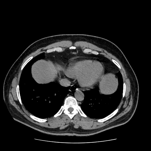 Adrenal myelolipoma and beaver tail liver (Radiopaedia 86201-102193 Axial non-contrast 22).jpg