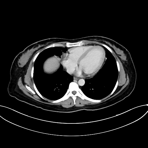 Adrenocortical carcinoma (Radiopaedia 87281-103569 Axial C+ portal venous phase 8).jpg