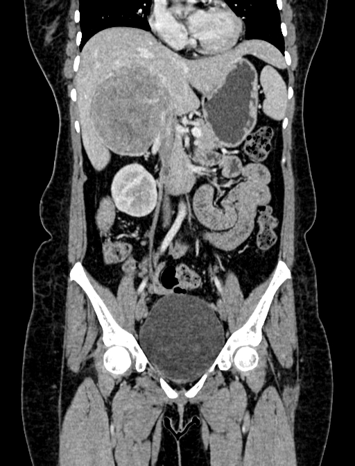 Adrenocortical carcinoma (Radiopaedia 87281-103569 Coronal C+ portal venous phase 32).jpg