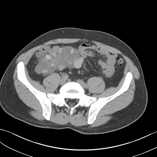 Adult polycystic kidney disease (Radiopaedia 47866-52626 Axial non-contrast 57).png