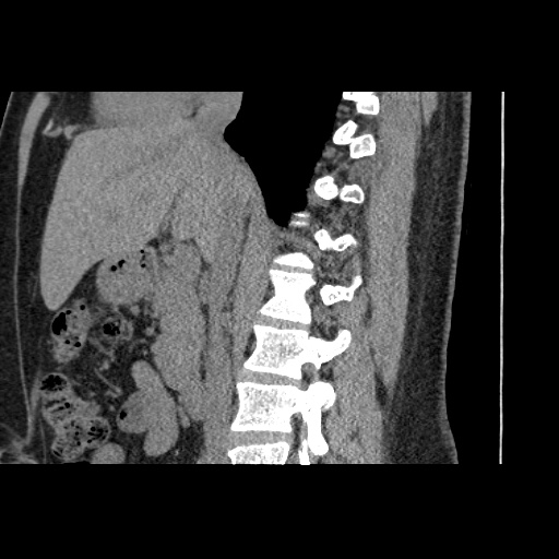 Adult polycystic kidney disease (Radiopaedia 59075-66368 Sagittal non-contrast 36).jpg
