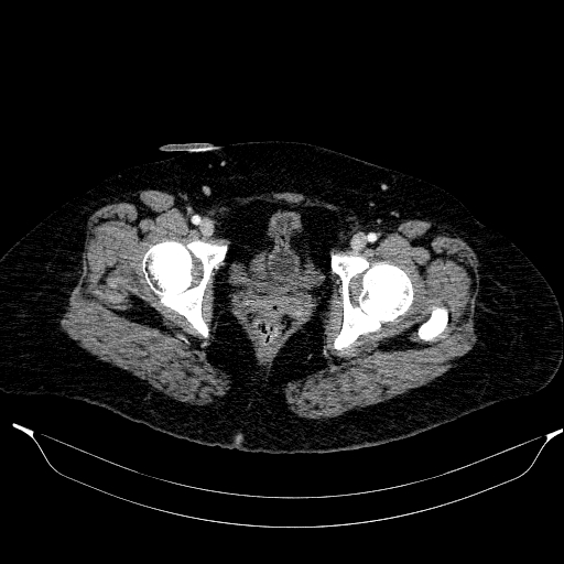 File:Afferent loop syndrome - secondary to incarcerated trocar site hernia (Radiopaedia 82959-97305 Axial C+ portal venous phase 225).jpg
